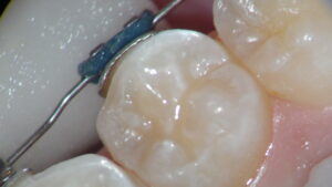 Stay Vigilant During Teen Orthodontics — A Practical Guide to Prevent Cavities and White Spots