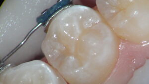 ティーンの矯正中こそ要注意！むし歯（ホワイトスポット）からお子さんの歯を守る徹底ガイド