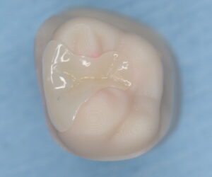 Are Ceramic Restorations Beautiful but Feel Like Multiple Visits Make Treatment Difficult…?