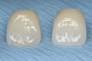 Tokyo International Dental Clinic Roppongi — Zirconia Ceramic & Metal-Free Restorations by Dr. Hiroshi Miyashita
