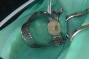 Is Your Cavity Treatment Harming Your Teeth? Discover the Secret to Gentle, Effective Care
