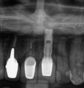 Are Implants Forever? Surprising Truths and Current Evidence on Treating Peri‑Implantitis