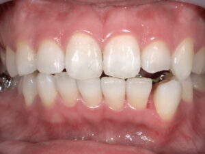 A Specialist Explains: Tooth-Safe Whitening  Tokyo International Dental Clinic Roppongi