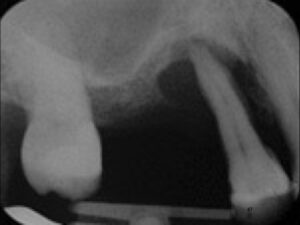 Teeth Feeling Loose? Don’t Panic! [University of Gothenburg Certified] Periodontist Offers Hope & Solutions