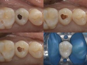 Don’t Give Up on Your Precious Tooth Nerve – The Latest Treatment to Nurture Your Future Smile