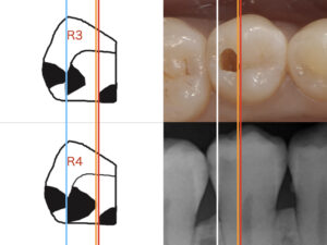 [AI is Transforming Dental Diagnosis] A Next-Generation Digital Second Opinion That Finds “Hidden Caries” Previously Missed