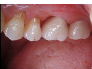 Protect Your Molars — Preserve Teeth with the Non‑Extraction Procedure “Root Resection”