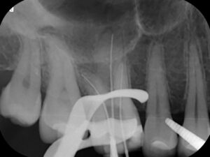 The Tooth Nerve Must Be Removed