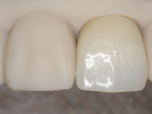 Is Your Ceramic Treatment Truly Effective? The Importance of Precision to Prevent Recurrence and How to Choose Your Dentist