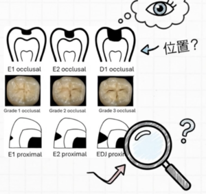 Is “cavity = drill immediately” already outdated? What the latest research reveals about the current state of “non-drilling” treatments
